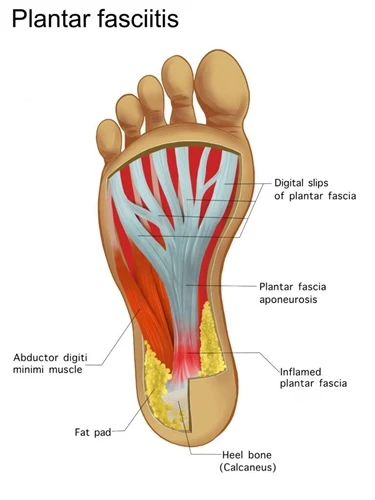 Os sapatos de segurança causam fascite plantar